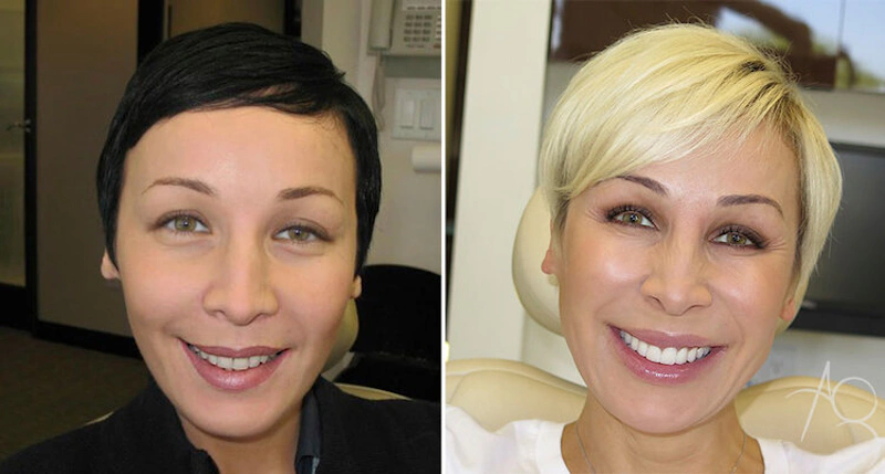 Smile Makeover Before & After Gallery - Patient 167602690 - Image 1