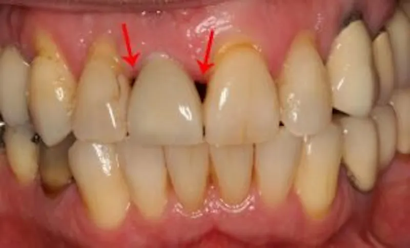 teeth with black holes
