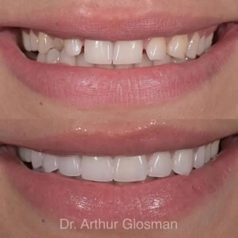 veneers results