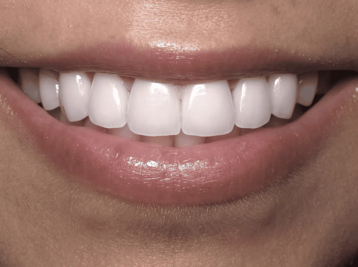 white teeth
