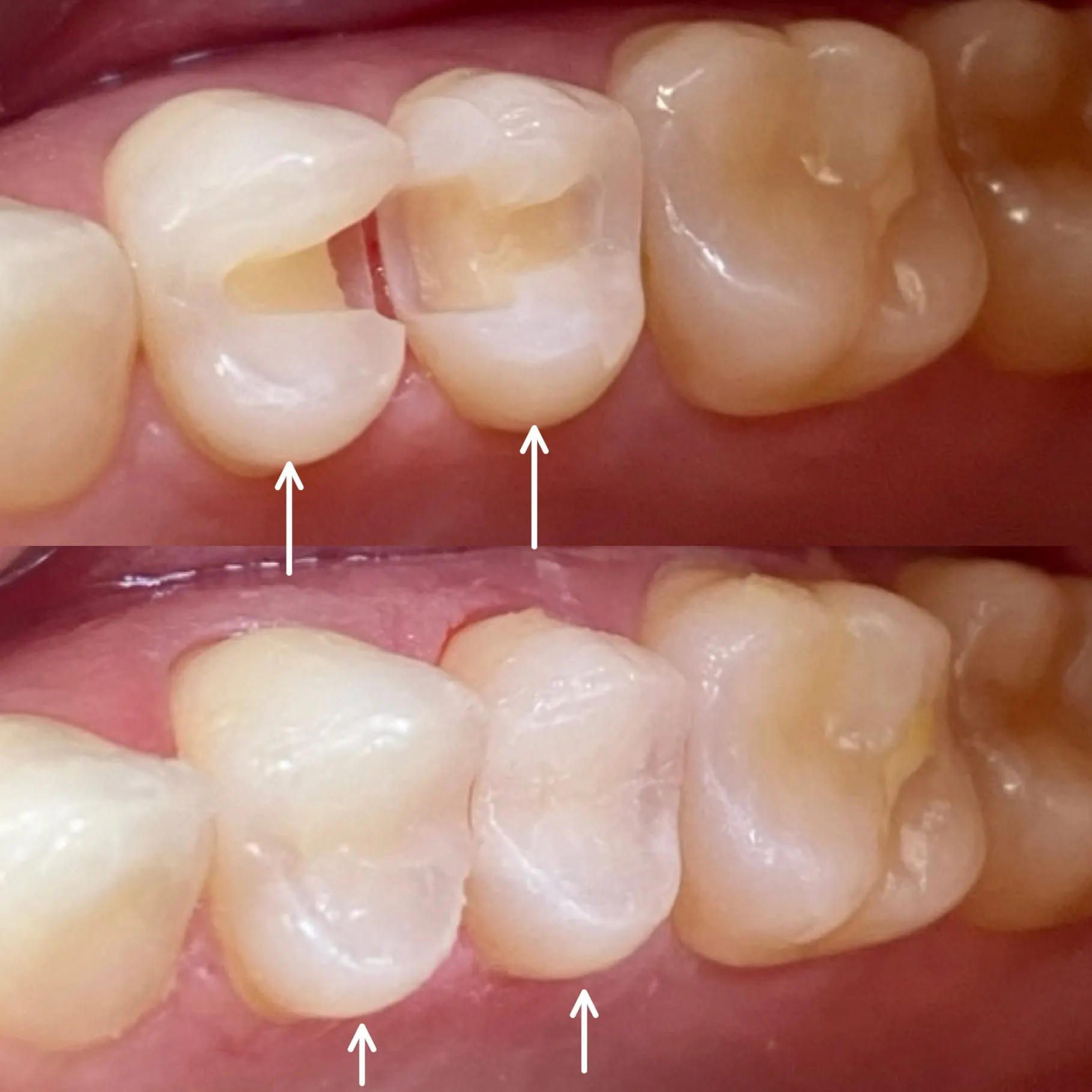 Metal-Free Fillings