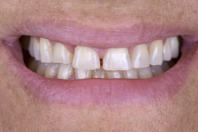 Porcelain Veneer Before