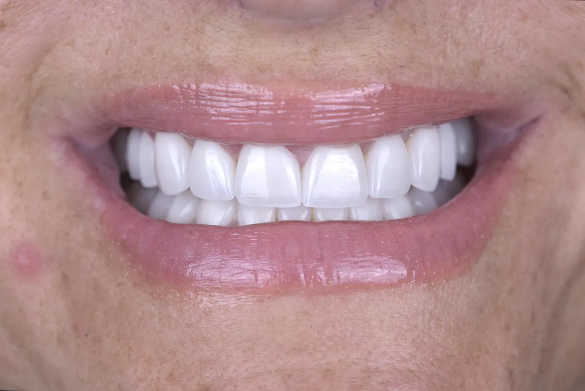 Porcelain Veneer After
