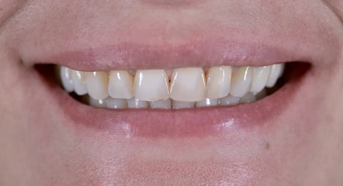 Smile Makeover Before