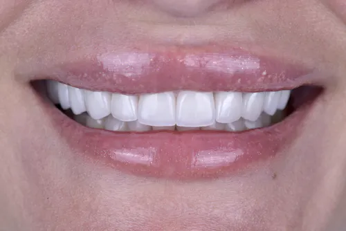 Smile Makeover After