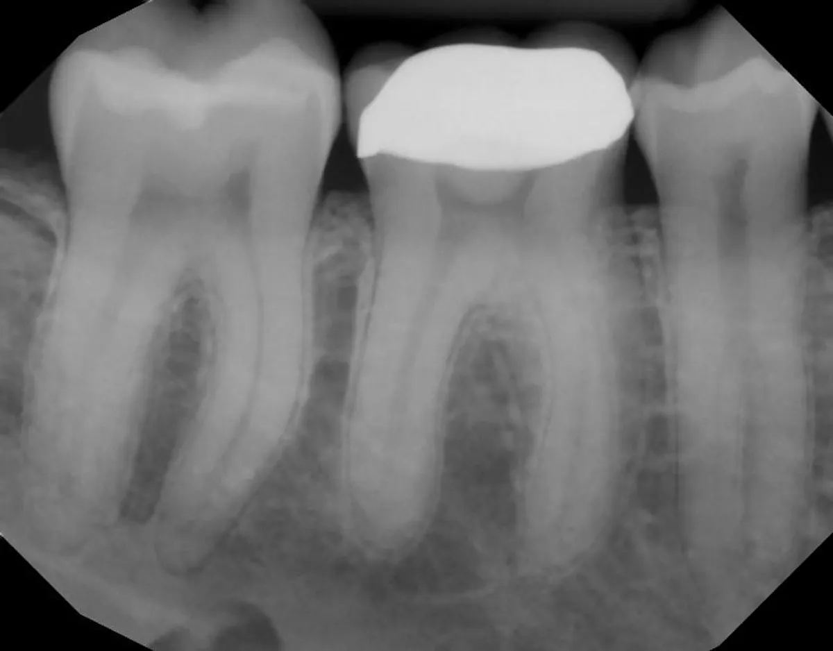 Root Canal Before
