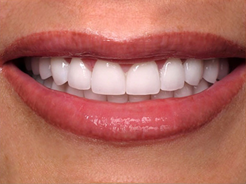 Smile Makeover Closeups Before & After Gallery - Patient 186105659 - Image 2