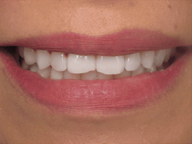 Smile Makeover Closeups Before & After Gallery - Patient 186105661 - Image 1
