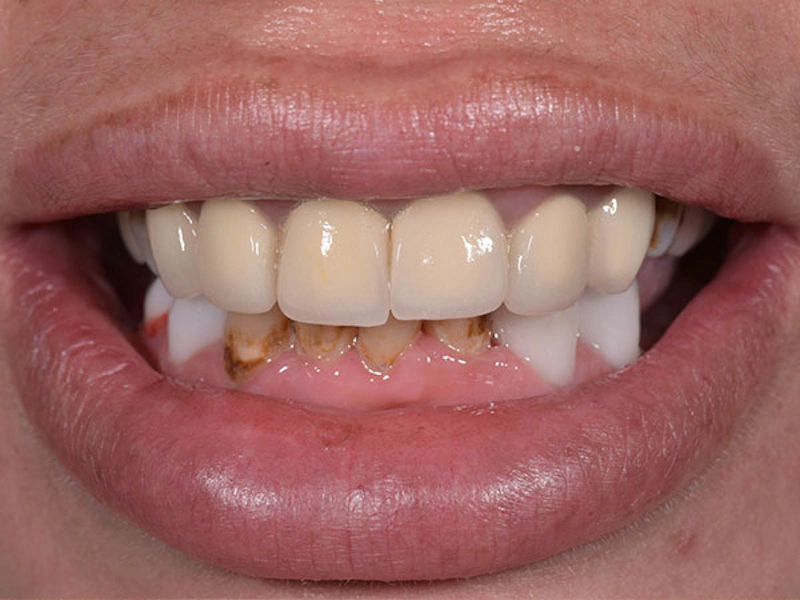 Smile Makeover Closeups Before & After Gallery - Patient 186106823 - Image 1