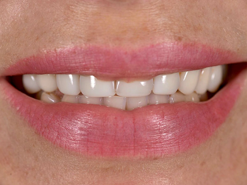 Smile Makeover Closeups Before & After Gallery - Patient 186106824 - Image 1