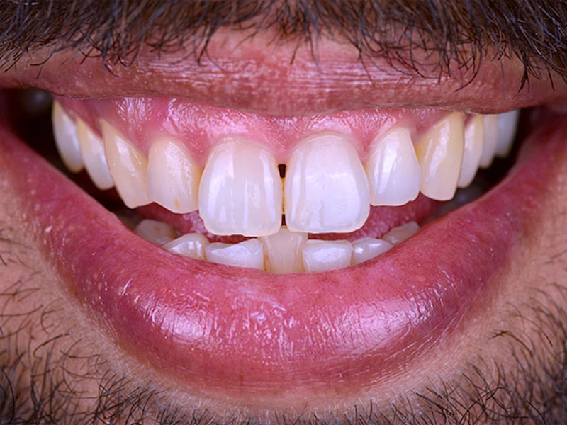 Smile Makeover Closeups Before & After Gallery - Patient 186106832 - Image 1