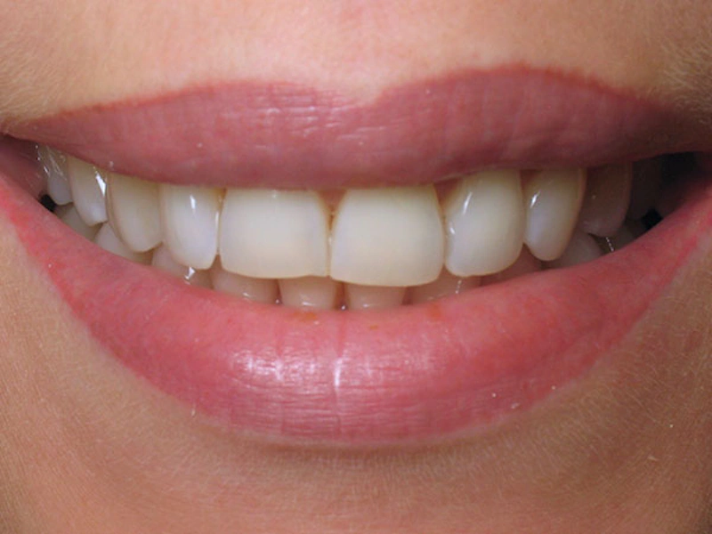 Smile Makeover Closeups Before & After Gallery - Patient 186106835 - Image 1