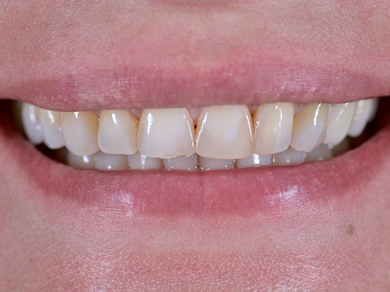 Smile Makeover Closeups Before & After Gallery - Patient 186106847 - Image 1