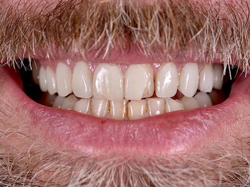 Smile Makeover Closeups Before & After Gallery - Patient 186106849 - Image 1