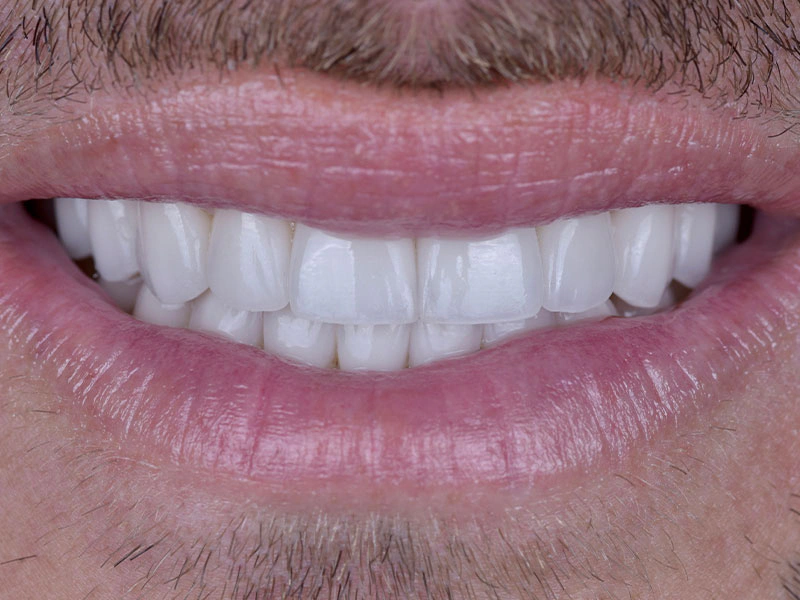 Smile Makeover Closeups Before & After Gallery - Patient 192281093 - Image 2