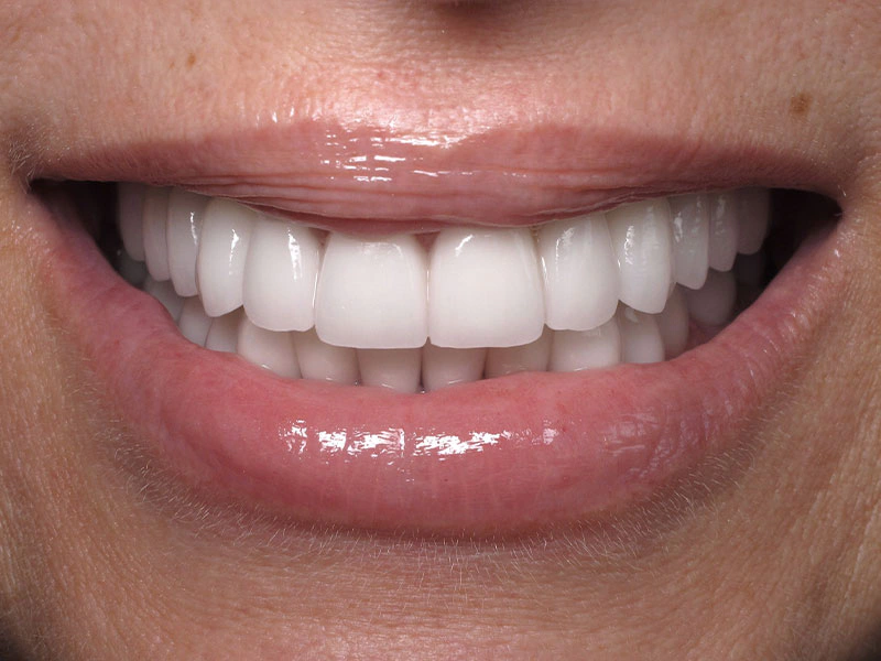 Smile Makeover Closeups Before & After Gallery - Patient 192281090 - Image 2