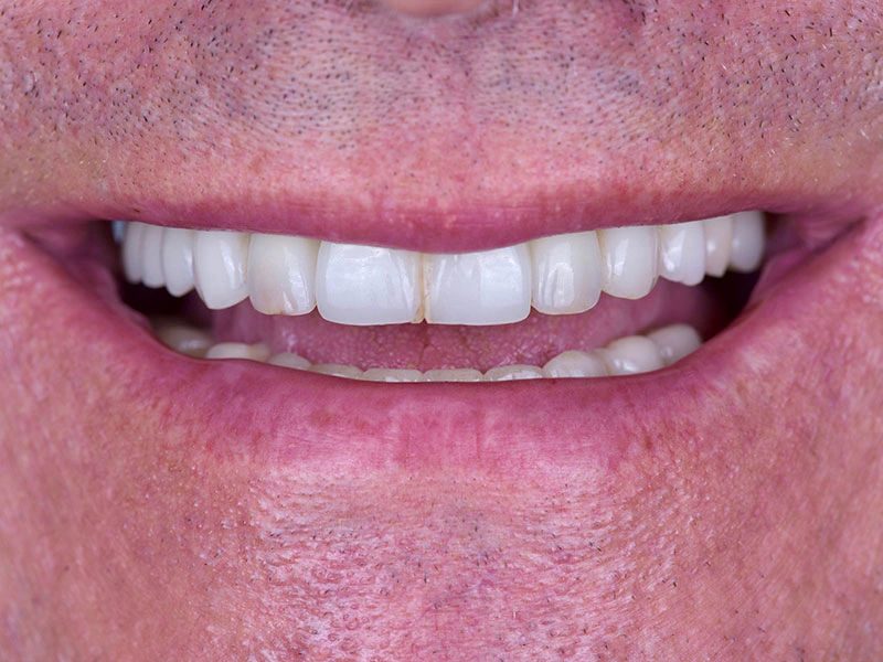 Smile Makeover Closeups Before & After Gallery - Patient 192281092 - Image 1