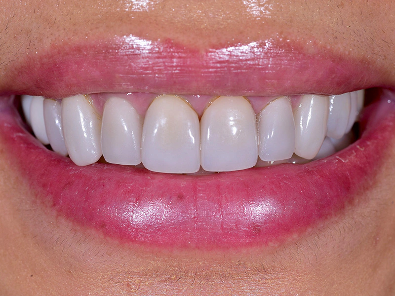 Smile Makeover Closeups Before & After Gallery - Patient 148992 - Image 1