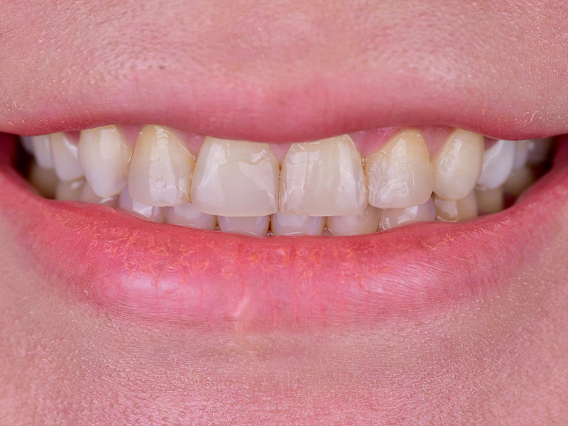 Smile Makeover Closeups Before & After Gallery - Patient 248724 - Image 1