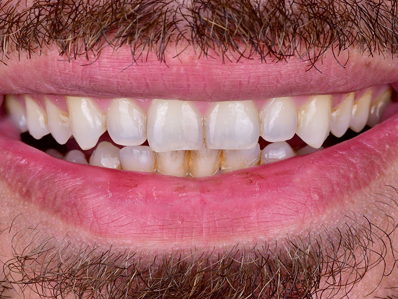 Smile Makeover Closeups Before & After Gallery - Patient 973947 - Image 1