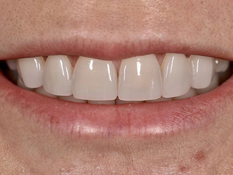 Smile Makeover Closeups Before & After Gallery - Patient 353445 - Image 1