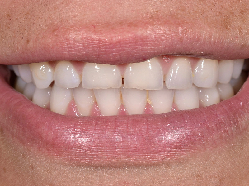 Smile Makeover Closeups Before & After Gallery - Patient 100593 - Image 1