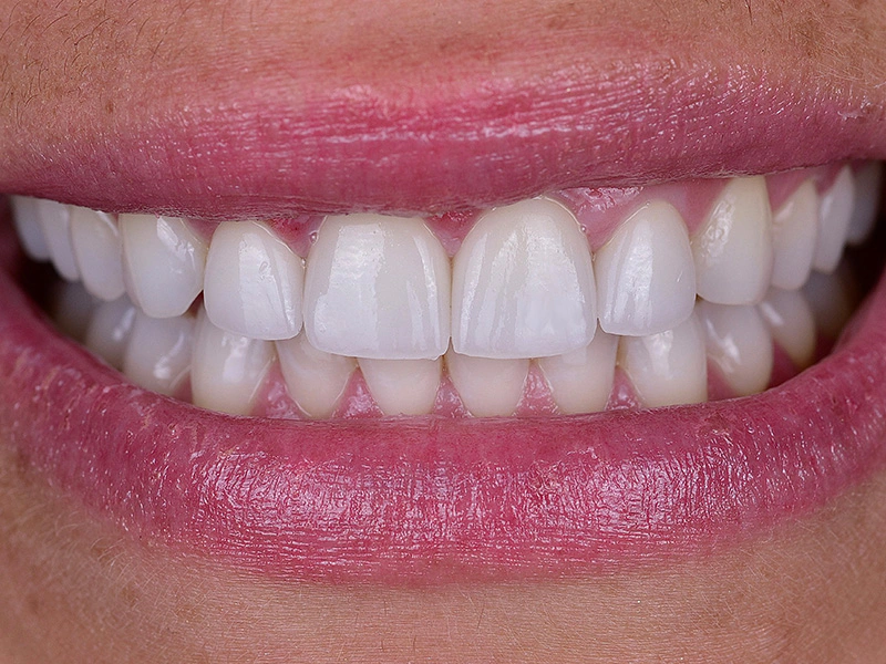 Smile Makeover Closeups Before & After Gallery - Patient 100593 - Image 2