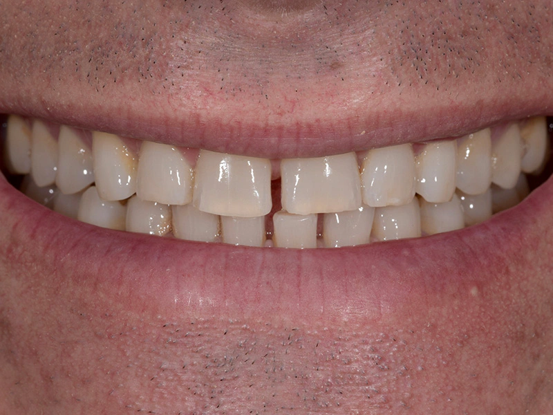 Smile Makeover Closeups Before & After Gallery - Patient 336517 - Image 1
