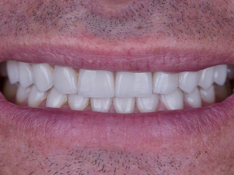 Smile Makeover Closeups Before & After Gallery - Patient 336517 - Image 2