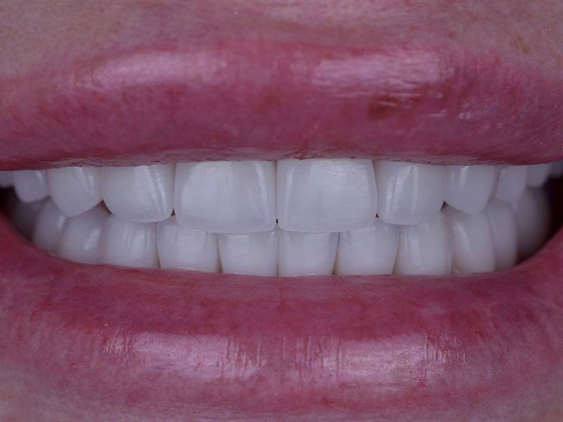 Smile Makeover Closeups Before & After Gallery - Patient 216343 - Image 2