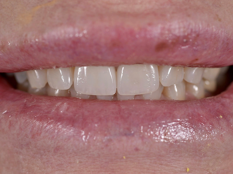 Smile Makeover Closeups Before & After Gallery - Patient 216343 - Image 1