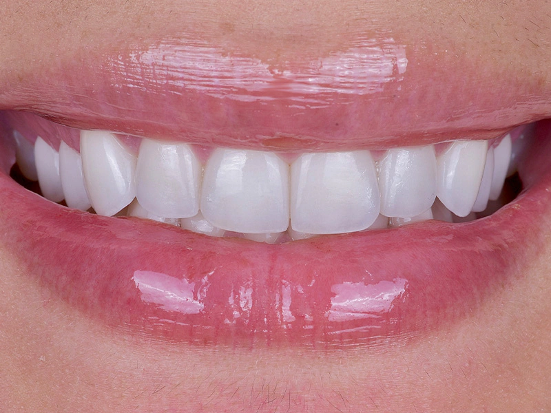 Smile Makeover Closeups Before & After Gallery - Patient 172040 - Image 2