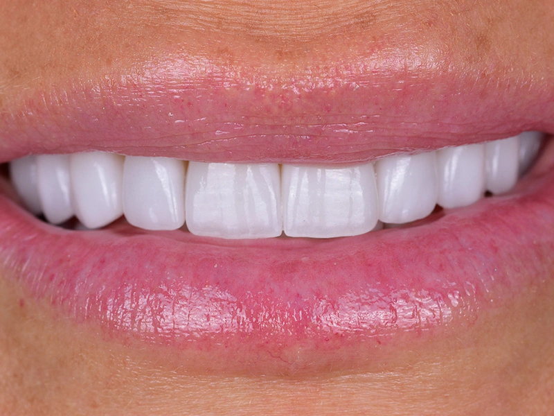 Smile Makeover Closeups Before & After Gallery - Patient 426330 - Image 2