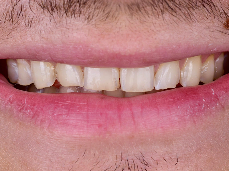 Smile Makeover Closeups Before & After Gallery - Patient 321702 - Image 1
