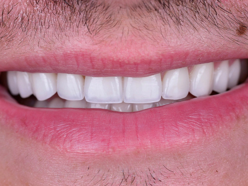 Smile Makeover Closeups Before & After Gallery - Patient 321702 - Image 2