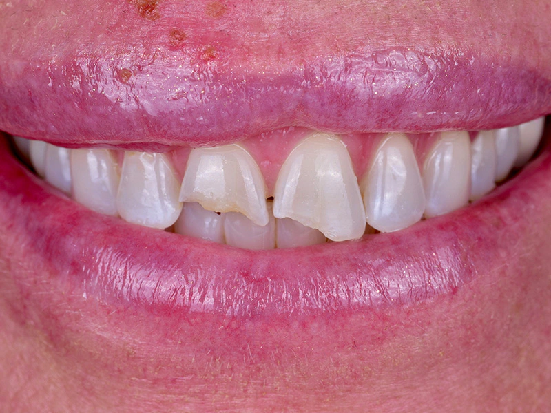 Smile Makeover Closeups Before & After Gallery - Patient 378550 - Image 1