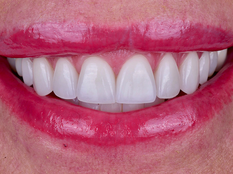 Smile Makeover Closeups Before & After Gallery - Patient 378550 - Image 2