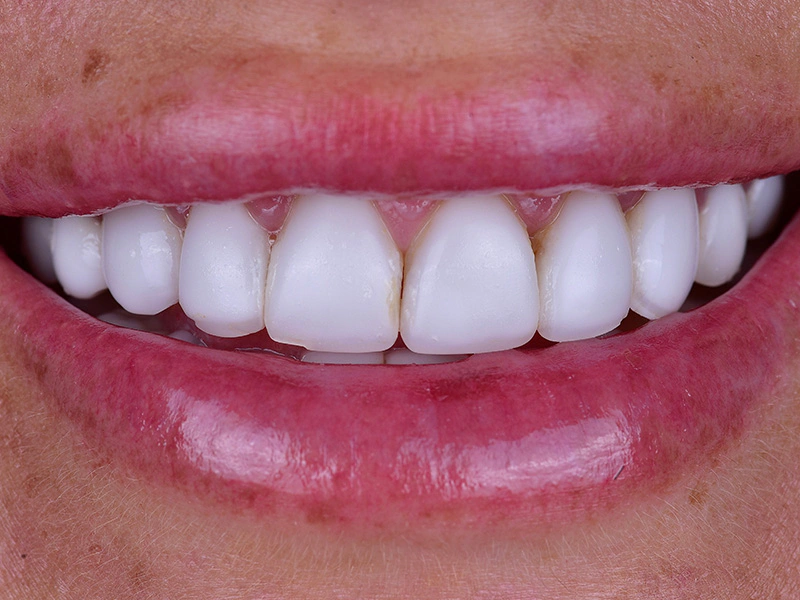 Smile Makeover Closeups Before & After Gallery - Patient 412839 - Image 1