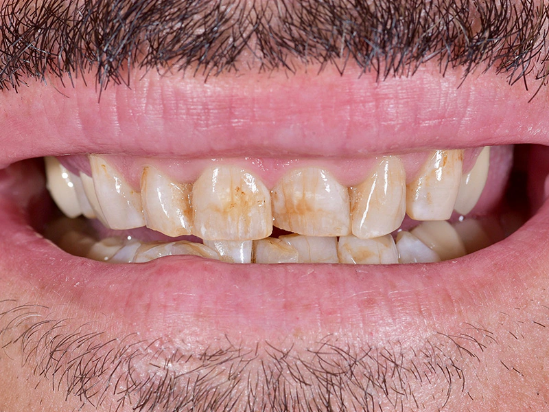 Smile Makeover Closeups Before & After Gallery - Patient 316958 - Image 1
