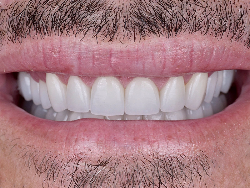 Smile Makeover Closeups Before & After Gallery - Patient 316958 - Image 2