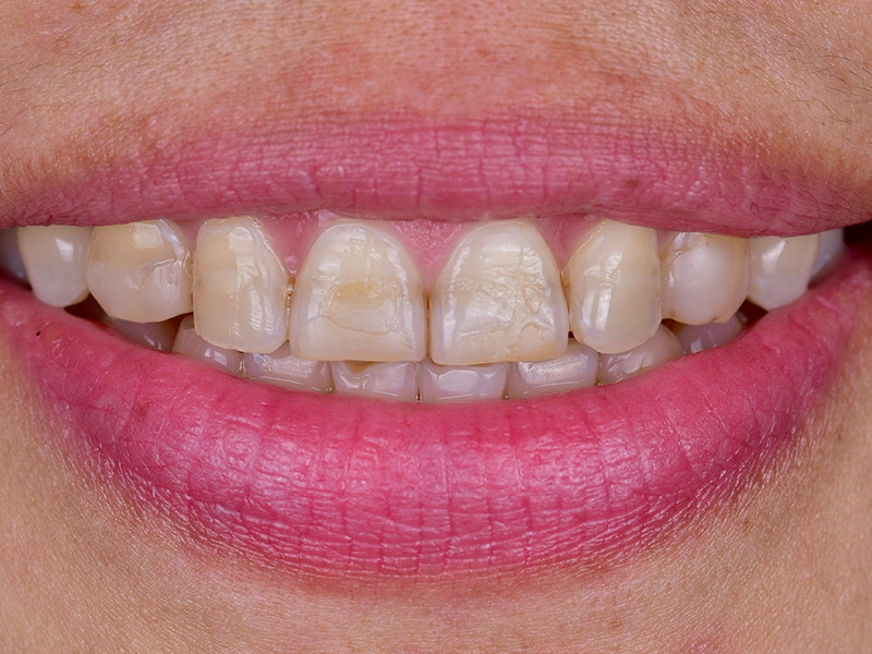 Smile Makeover Closeups Before & After Gallery - Patient 339370 - Image 1