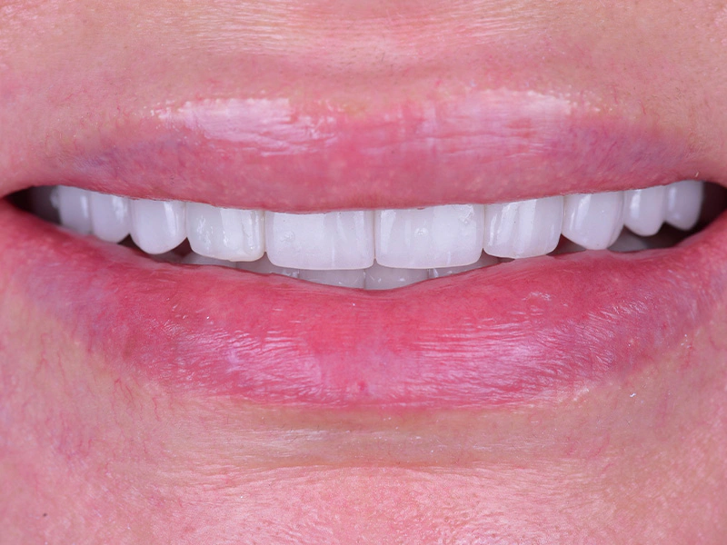 Smile Makeover Closeups Before & After Gallery - Patient 303810 - Image 1