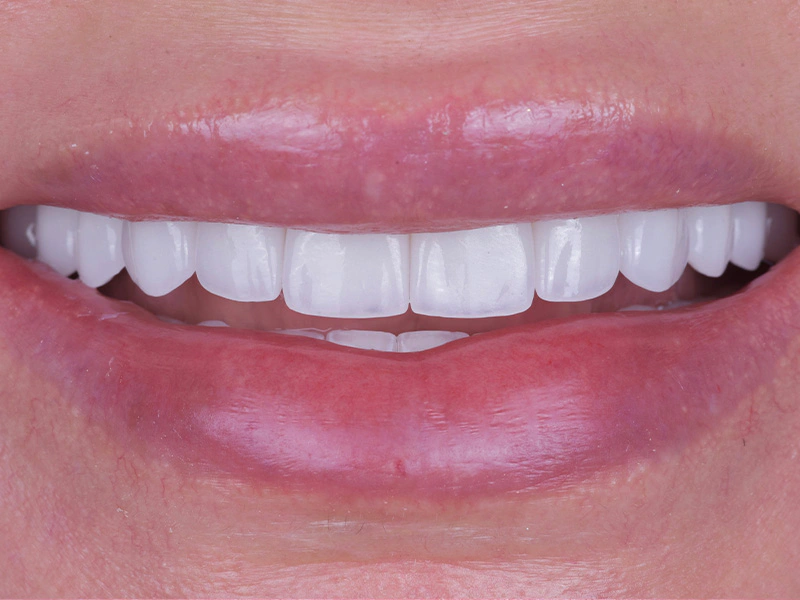 Smile Makeover Closeups Before & After Gallery - Patient 303810 - Image 2