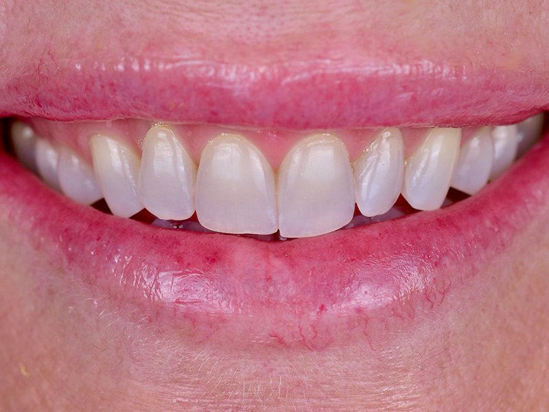 Smile Makeover Closeups Before & After Gallery - Patient 111201 - Image 1