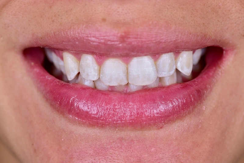 Smile Makeover Closeups Before & After Gallery - Patient 172040 - Image 1